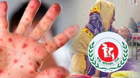 হামের উপসর্গে আরও ৪ শিশুর মৃত্যু