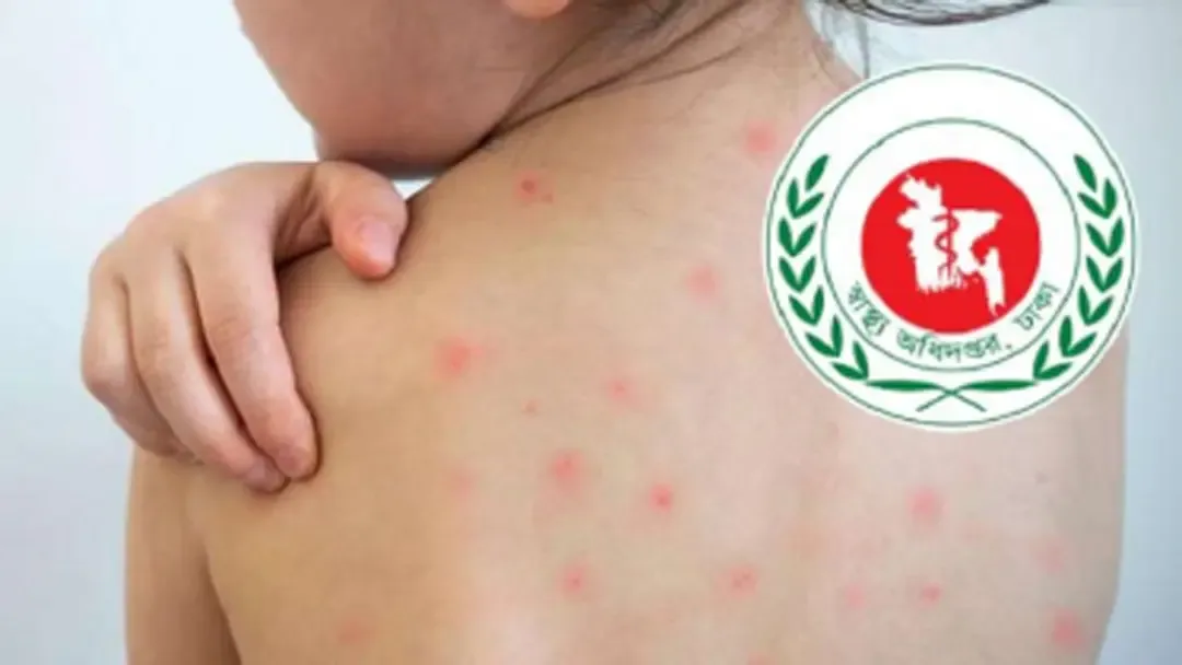 হাম ও হামের উপসর্গে আরো তিন জনের মৃত্যু