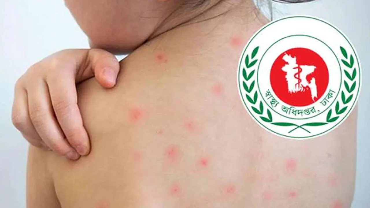 হামের উপসর্গে ২৪ ঘণ্টায় ৮ জনের মৃত্যু