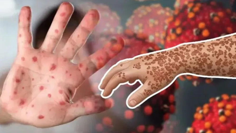 হামের উপসর্গ নিয়ে আরও ২ শিশুর মৃত্যু