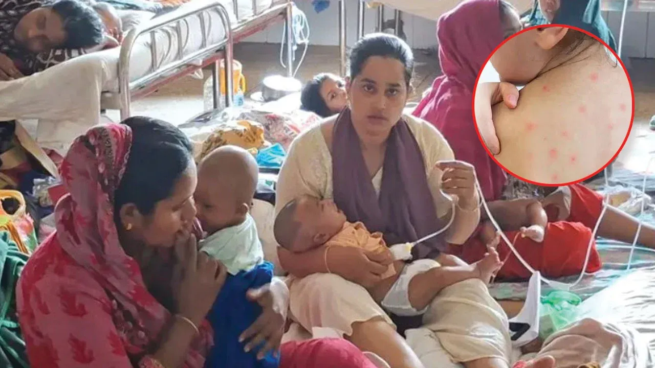 হামের উপসর্গে একদিনে আরো ৫ শিশুর মৃত্যু