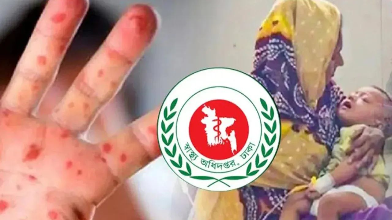 হাম ও হামের উপসর্গে শিশু মৃত্যু ৫০০ ছাড়াল