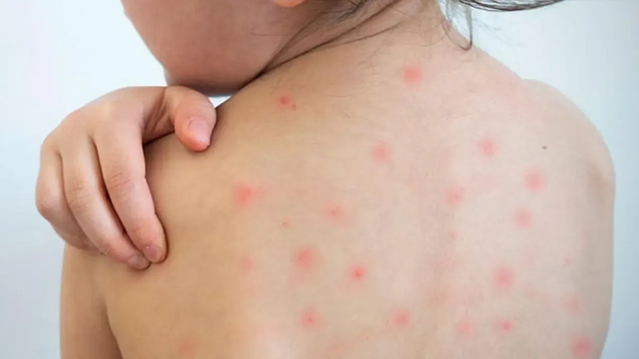 হামের উপসর্গ নিয়ে আরও ৪ শিশুর মৃত্যু
