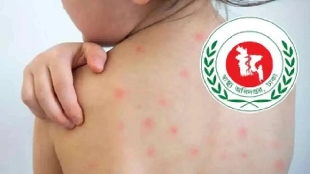 হাম উপসর্গে আরও ৫ জনের মৃত্যু