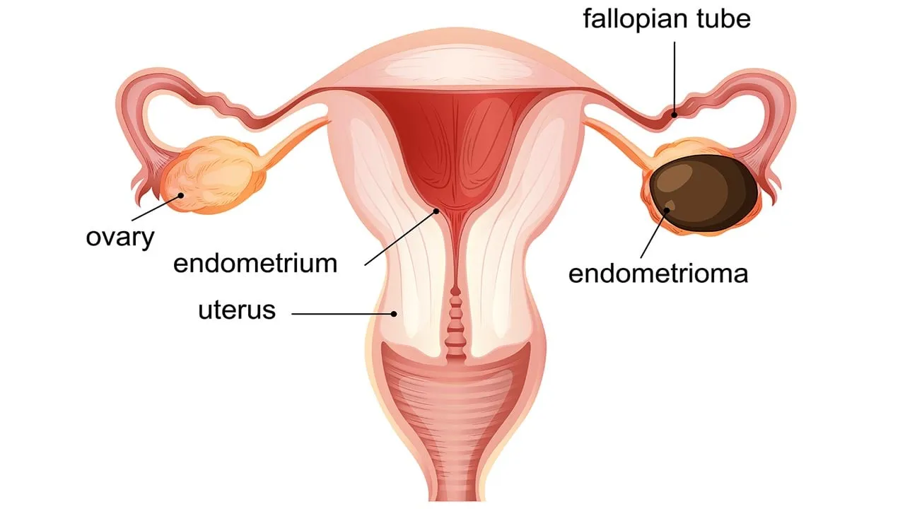 চকলেট সিস্ট? আপনার যা জানা জরুরি