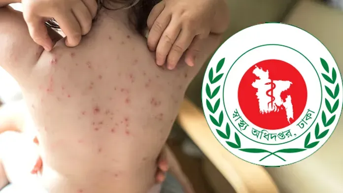 হামের উপসর্গে ২৪ ঘণ্টায় ৮ জনের মৃত্যু