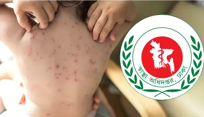 হামের উপসর্গে ২৪ ঘণ্টায় ৭ জনের মৃত্যু