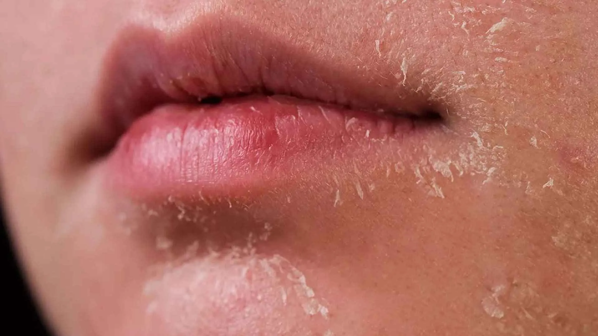 ত্বকের এই সমস্যাগুলোই হতে পারে কিডনি খারাপের ইঙ্গিত